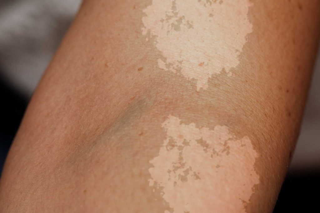 Clearing the Hues: Can Discoloration on Legs Truly Go Away?"